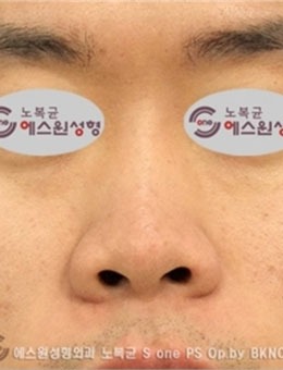 韩国SONE整形男士做鼻子术前术后两个月对比图分享！