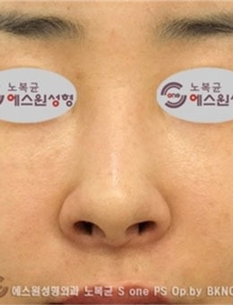 在韩国SONE整形做的鼻修复，术后很自然！_术前