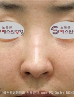 在韩国SONE整形做的鼻修复，术后很自然！