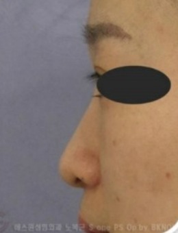 韩国sone整形鼻子整形好吗？从图看隆鼻技术和审美都很赞！