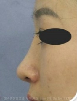 韩国sone整形鼻子整形好吗？从图看隆鼻技术和审美都很赞！