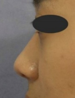 韩国sone整形外科做鼻子怎么样,汇总术前术后亲身体验攻略!_术前