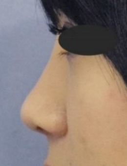 韩国sone整形外科做鼻子怎么样,汇总术前术后亲身体验攻略!