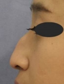 驼峰鼻矫正手术靠谱吗?速来看韩国sone整形外科真人对比!