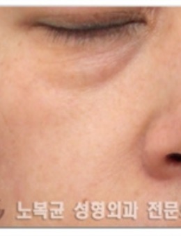 韩国Sone整形外科下眼睑真人对比太惊艳！看着好自然_术前