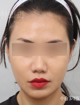 -韩国V.LIF比丽普整形外科做面部提升很出名,附前后对比照!
