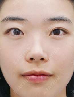 韩国jayjun整形做隆鼻好吗？谁去过他们家做鼻子说下！_术前
