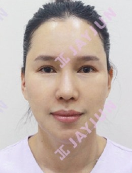 公開韓國jayjun整形隆鼻修復+面部拉皮手術前后圖！