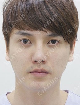 在韩国JAYJUN整形做了眼睛鼻子维纳斯吸脂提升，变身帅气小哥哥！