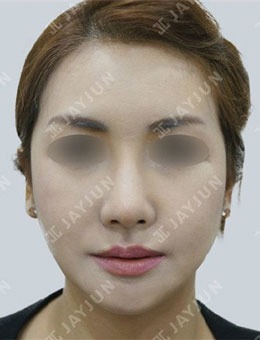 韓國JAYJUN整形臉型大改造，術后很驚艷！