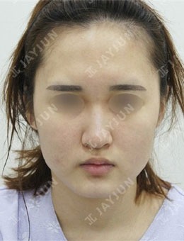 韓國JAYJUN整形下頜角+下巴整形對比圖分享，術后自然又好看！