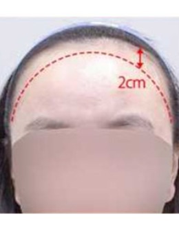 -打造头包脸精致感就来韩国seojin整形外科,植发一步解决!