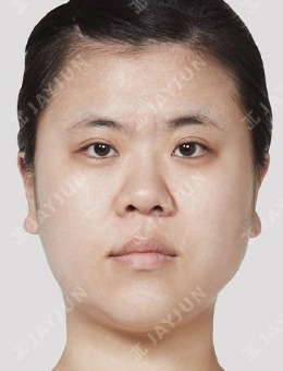 全臉整形又瘦又美，韓國jayjun整形面部整形照片來了！