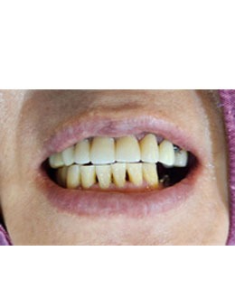 前牙缺失怎么辦？韓國D1牙科前牙美學修復了解一下！_術后