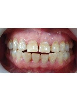 牙齒稀疏怎么辦?韓國D1牙科前牙美學修復來幫忙!_術前