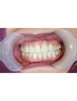 牙齒稀疏怎么辦?韓國D1牙科前牙美學修復來幫忙!_術后