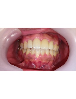 韓國D1牙科前牙美學修復對比照公開,不愧是有名牙科!_術后