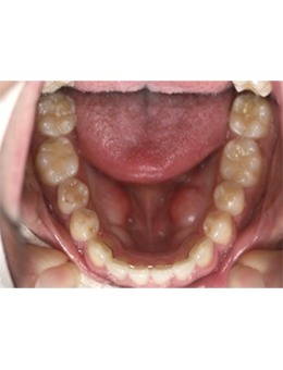 韓國牙齒矯正牙科推薦:D1牙科正畸有名也有實力!_術后