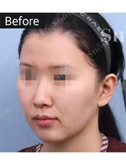 韩国snow整形外科面部填充，帮你打造精致“童颜感”_术前