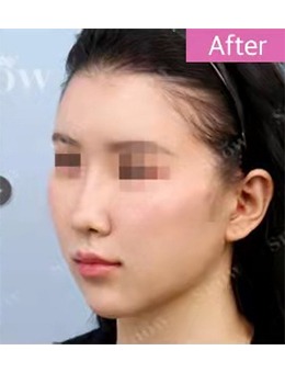 韩国snow整形外科面部填充，帮你打造精致“童颜感”_术后