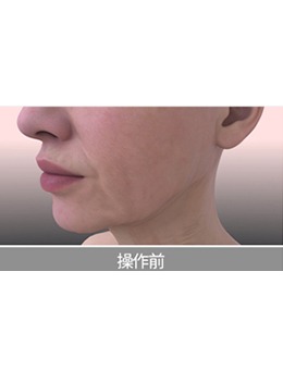 -韩国MinClinic皮肤科的韩版热玛吉术前术后能有多大变化!