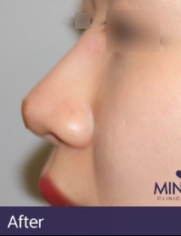 韩国minclinic玻尿酸隆鼻前后图公开，术后真自然！
