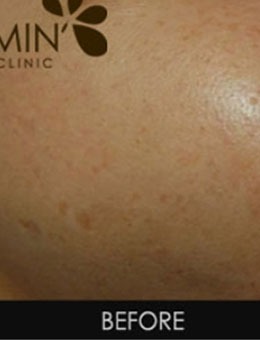 韩国MinClinic皮肤注射真香，面部肌肤年轻了很多！