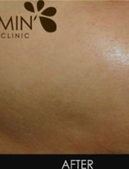 韩国MinClinic皮肤注射真香，面部肌肤年轻了很多！