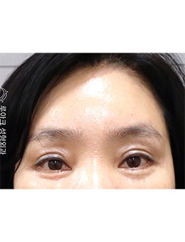 韩国luarc整形外科面部提升，改善皱纹不是盖的