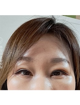 韩国luarc整形外科双眼皮+面部提升改善肿眼泡和皮肤松弛
