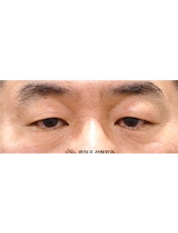 韩国luarc整形埋线双眼皮对比照公开，眼型都变好看了！