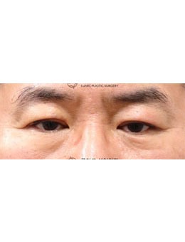韩国luarc整形埋线双眼皮对比照公开，眼型都变好看了！