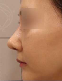 肉肉蒜头鼻也有春天！在韩国luarc整形外科拥有微翘直鼻
