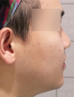 在韩国luarc整形外科拥有高挺鼻子，小伙前后对比惊人_术前