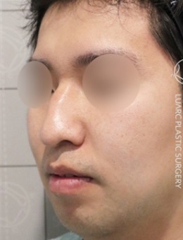 小伙在韩国luarc整形外科隆鼻前后对比，变身帅气欧巴！_术前