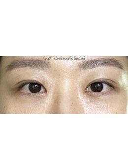 20岁女孩在韩国luarc整形外科割双眼皮，6个月后像换了个人！_术后