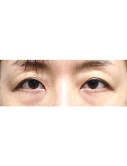 韩国做眼睛整形的医院里luarc整形很出名,附双眼皮手术对比照!