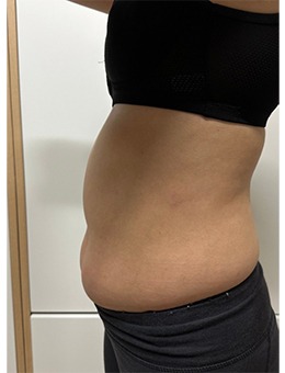 分享韩国清潭jasmine line clinic腰腹塑形，侧面对比太绝啦！_术前
