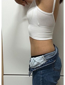 分享韩国清潭jasmine line clinic腰腹塑形，侧面对比太绝啦！_术后