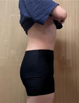 快来韩国清潭jasmine line clinic瘦腰，拥有性感好身材！