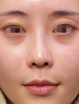 韩国EG童颜整形去眼袋技术好，不信的话直接看图！