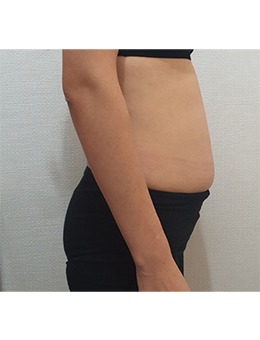 分享韩国清潭jasmine line clinic体型管理前后对比图，瘦腰收腹简直绝了！_术前
