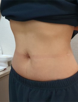 我来韩国清潭jasmine line clinic做了瘦腰管理!前后对比很惊艳!_术后