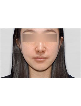 韩国macs口腔颌面外科双鄂手术对比图，变化惊人！