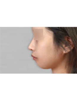 凸嘴矫正后脸型变化对明显!分享韩国maca口腔颌面外科真人例子!