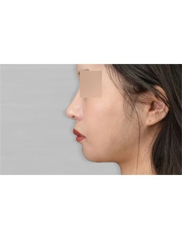 -凸嘴矫正后脸型变化对明显!分享韩国maca口腔颌面外科真人例子!