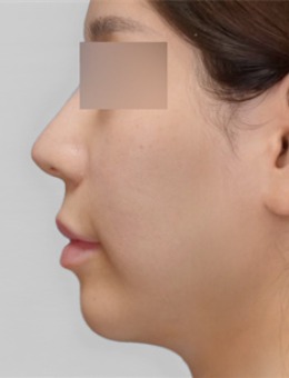 韩国macs口腔颌面外科真实分享！凸嘴改善太明显了！