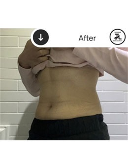 韩国清潭jasmine line clinic腰腹塑形对比图公开，真的很惊艳！_术后