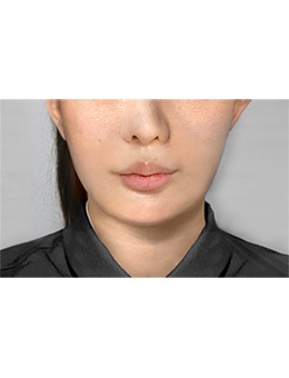 韩国macs口腔颌面外科v脸成形术超棒！改善大脸盘提升五官精致度