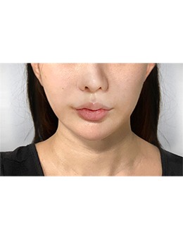 韩国macs口腔颌面外科v脸成形术超棒！改善大脸盘提升五官精致度